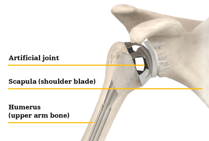Shoulder replacement
