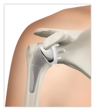 Total shoulder replacement