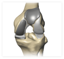 bicompartmental knee