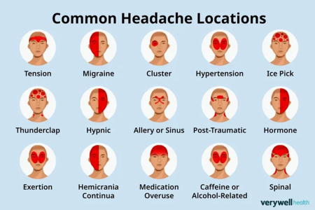 common headache locations