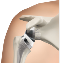 reverse-shoulder-replacement