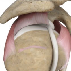 stryker-india-shoulder-massive-rct