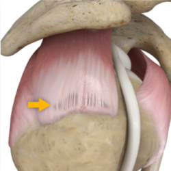 stryker-india-shoulder-partial-thickness-rct