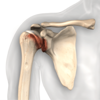 understanding-shoulder-pain-2